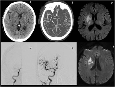 stroke vessel occlusion frontiersin sustenance penumbral pressure blood